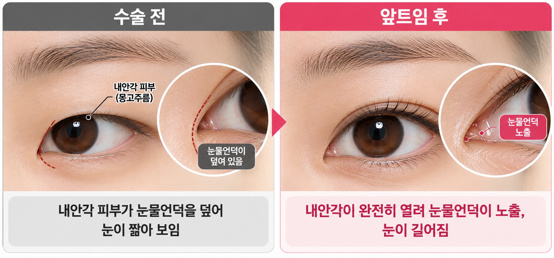 앞트임 전후 비교 인포그래픽