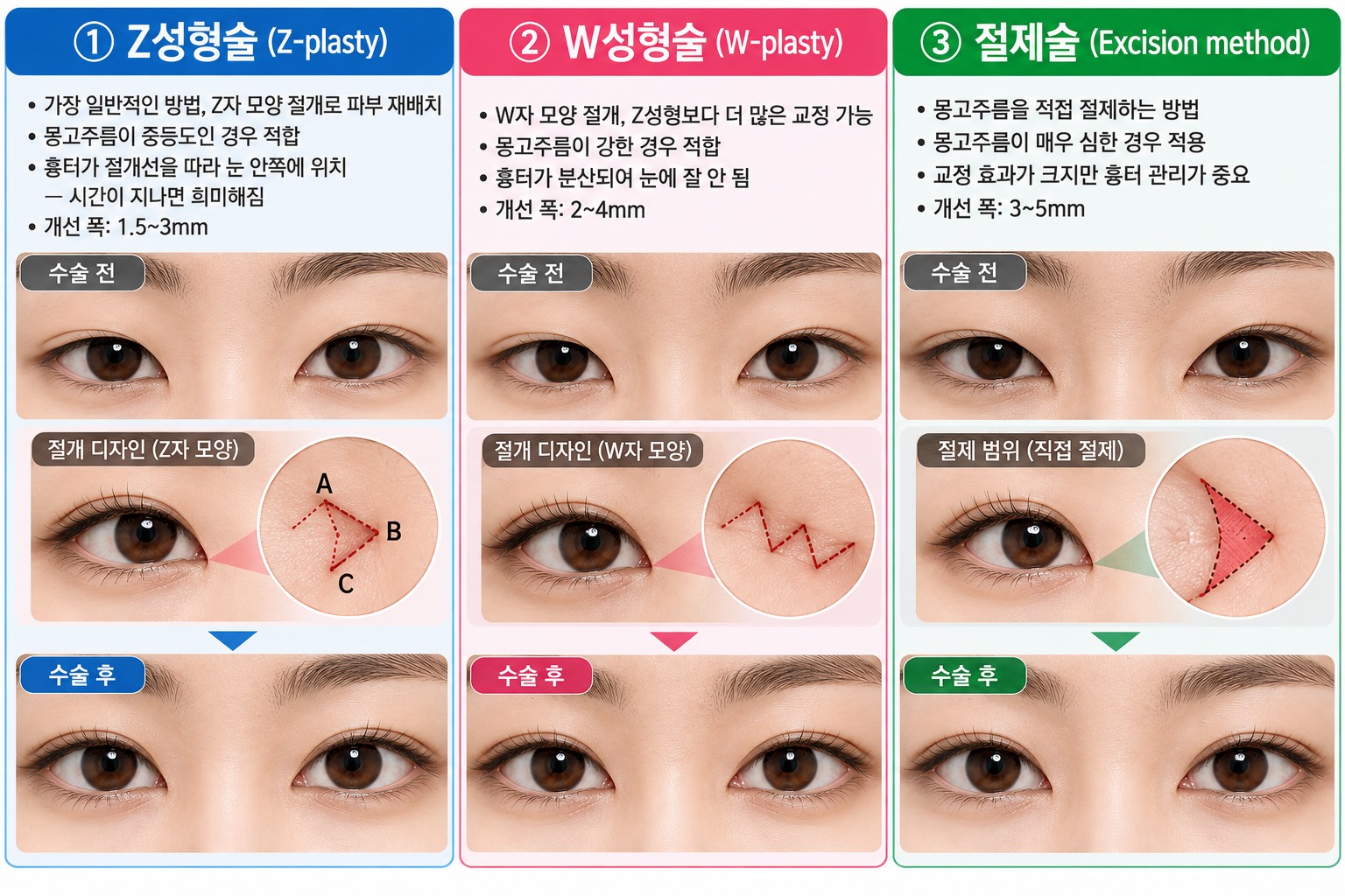 앞트임 수술 방법 비교 인포그래픽