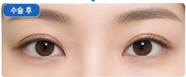 쌍꺼풀 클로즈업 매몰법 수술 후