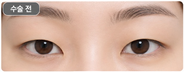 단꺼풀 클로즈업 쌍꺼풀 수술 전