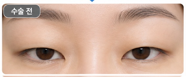 두꺼운 단꺼풀 클로즈업 절개법 전