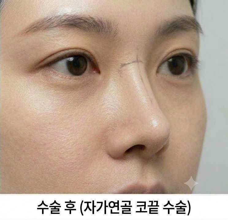 매부리코 교정 후 클로즈업