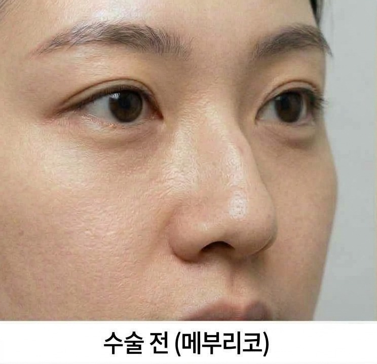 매부리코 교정 전 클로즈업
