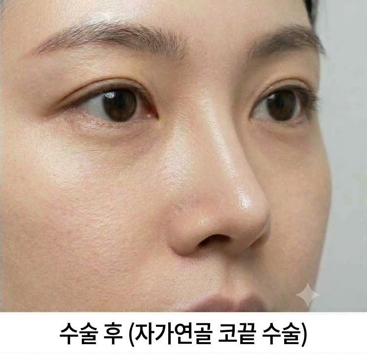 코끝 교정 후 클로즈업
