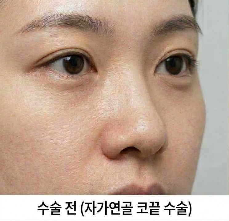 코끝 교정 전 클로즈업